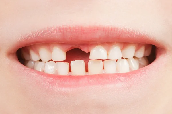 Barn med en tand utrymme — Stockfoto