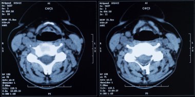 bir omuz xrays