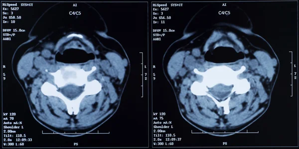 Рентген плеча — стоковое фото