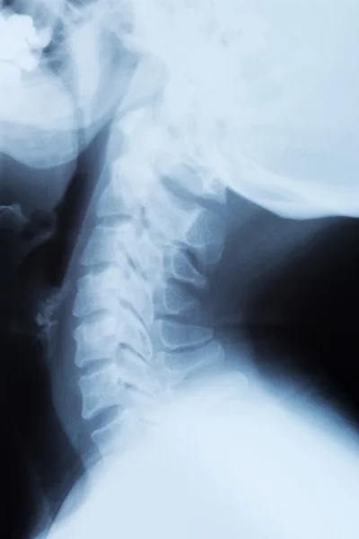 Røntgenbillede af en halshvirvelsøjle - Stock-foto