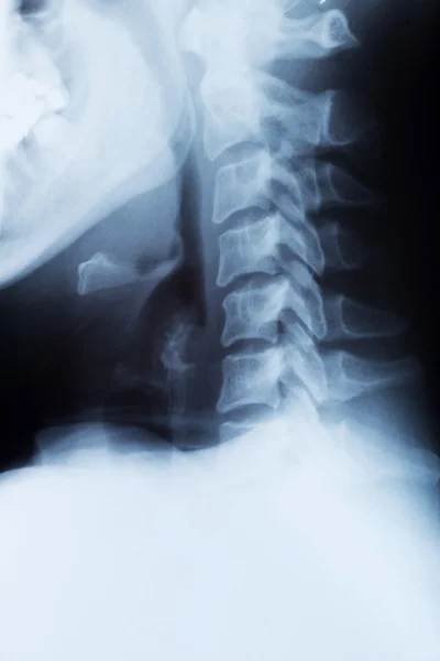 Röntgenbild einer Halswirbelsäule — Stockfoto