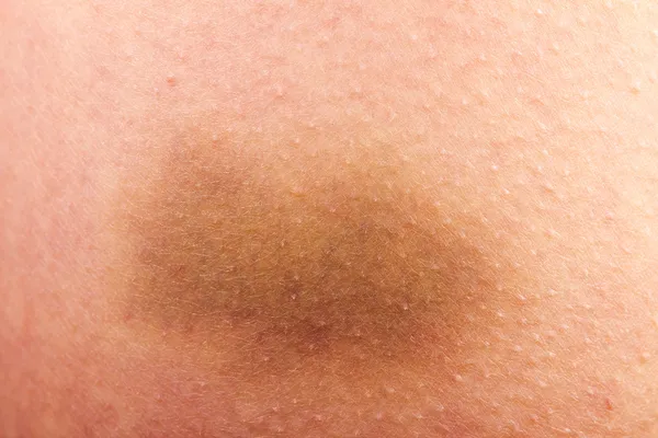 Bruise closeup — Stock Photo, Image