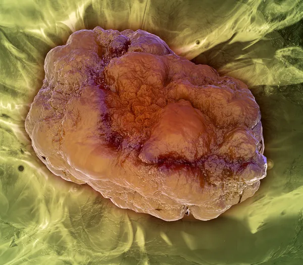 Formação de tumores — Fotografia de Stock