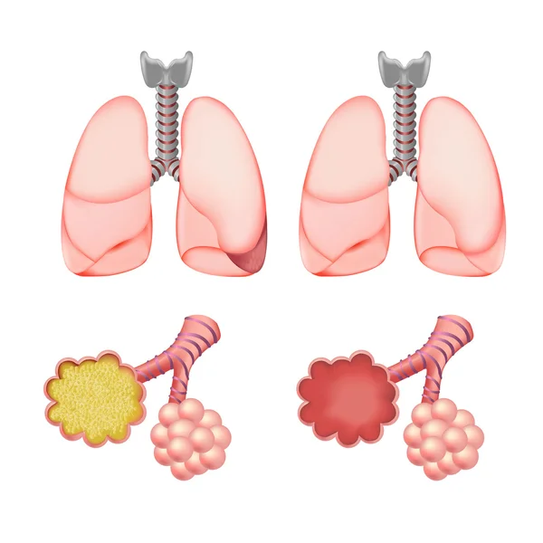 stock vector Alveoli In Lungs Set