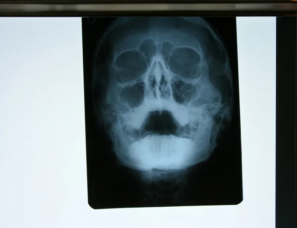 Insan kafatası x-ray — Stok fotoğraf