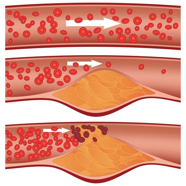 Placca di colesterolo nell'arteria (aterosclerosi) illustrazione — Vettoriale Stock