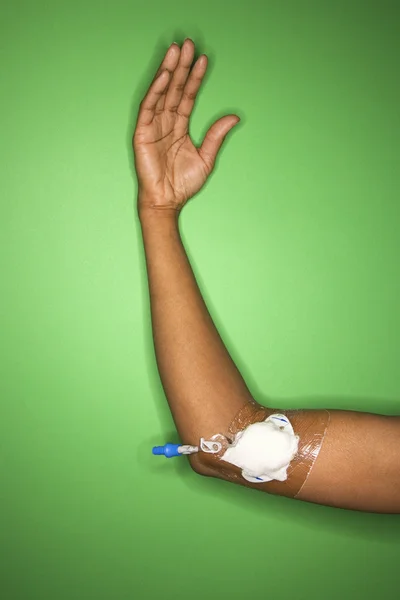 Arm with intravenous tube. — Stock Photo, Image