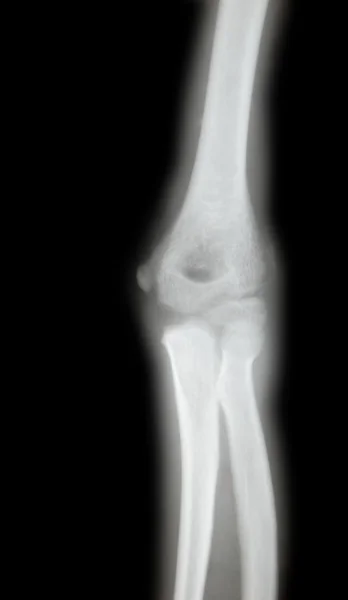 Radiografia di un braccio giovane — Foto Stock