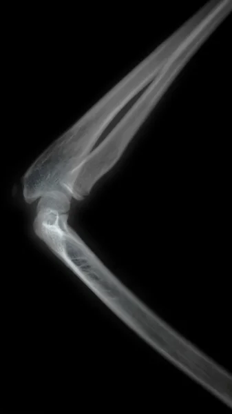 Genç bir kolunun röntgeni — Stok fotoğraf