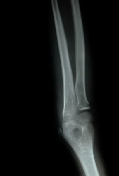 一个年轻的手臂的 x 射线 — 图库照片