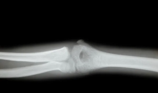 stock image X-ray of a young arm