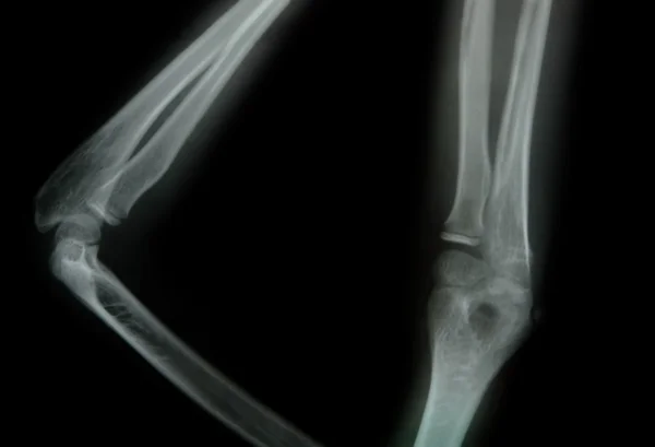 Röntgenbild av en ung arm — Stockfoto