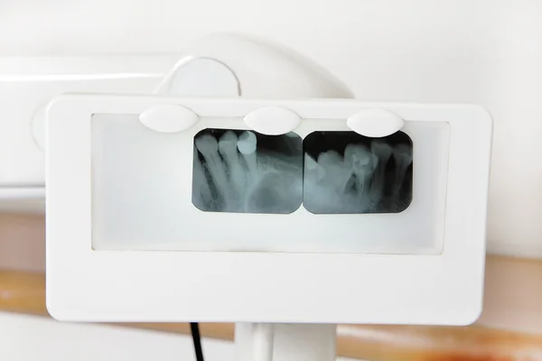 Röntgenbild der Zähne — Stockfoto