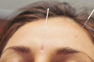 Acupuncture needles clipart