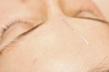 Accupuncture treatment clipart