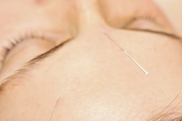 Accupuncture treatment — Stock Photo, Image