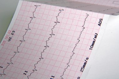 cardiograma, gráfico de ecg