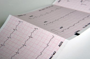 cardiograma, gráfico de ecg