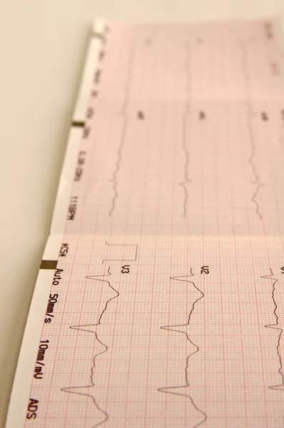 Cardiogram, ecg grafiek — Stockfoto