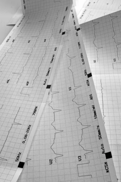 Cardiografía, gráfico ECG — Foto de Stock