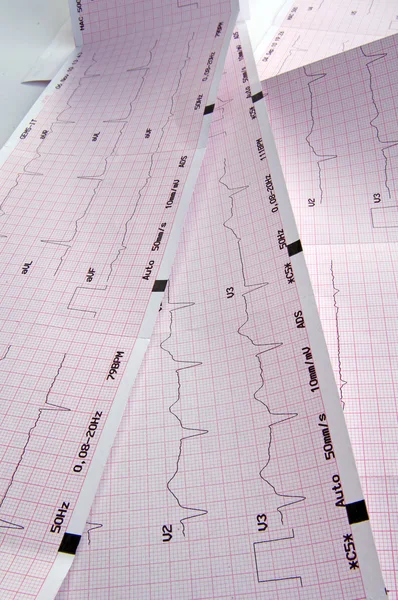 Elektrokardiogram, EKG-diagram — Stockfoto