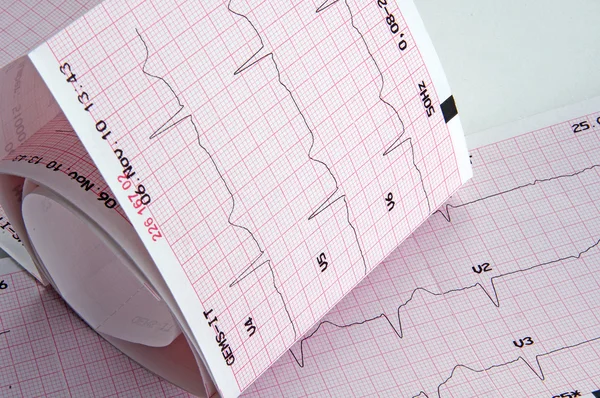 Cardiogram, EKG grafikon — Stock Fotó