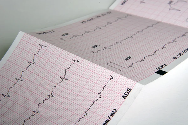 Kardiogram, EKG graf — Stock fotografie