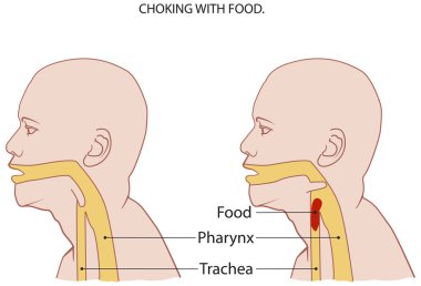 Choking clipart