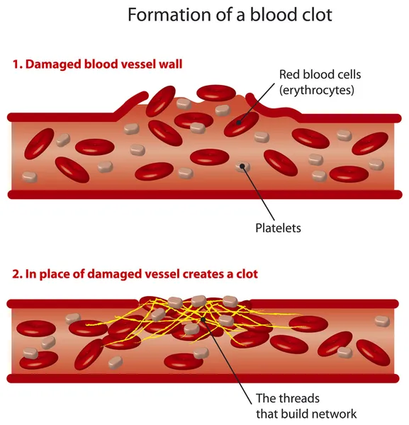 Тромбы крови — стоковый вектор