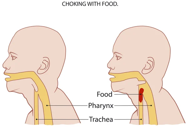 Choking — Stock Vector