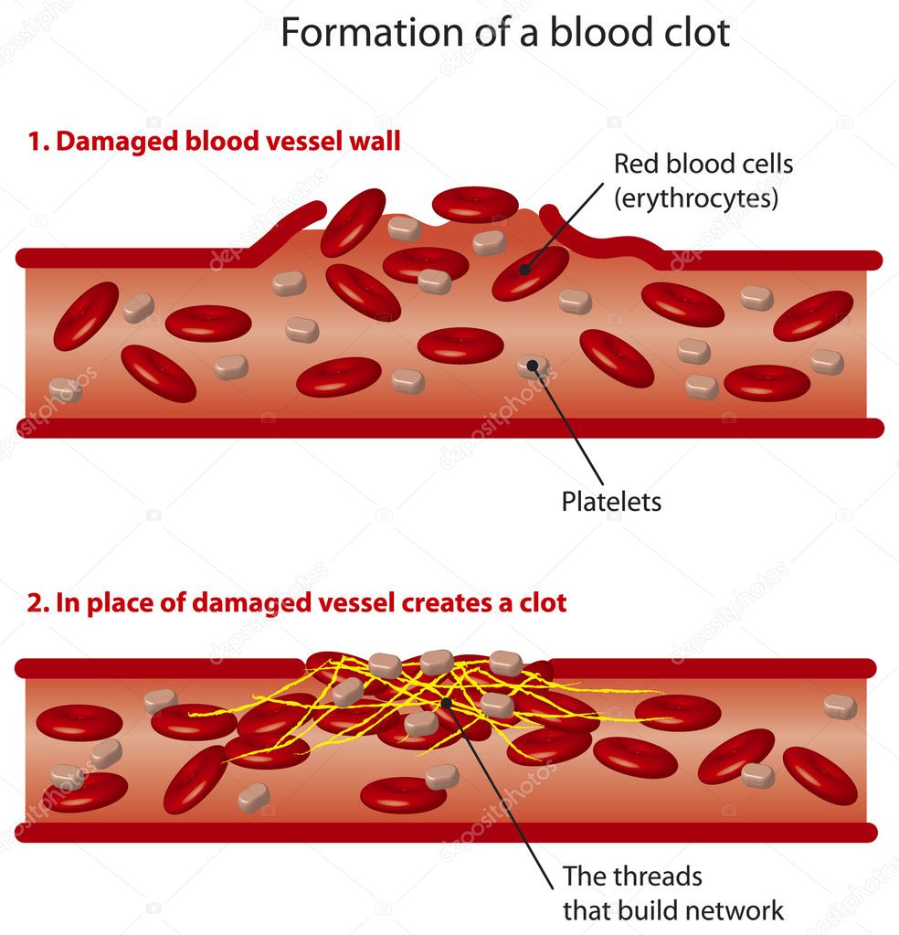 Blood clots