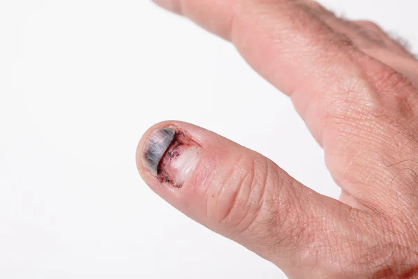Uña del dedo — Foto de Stock
