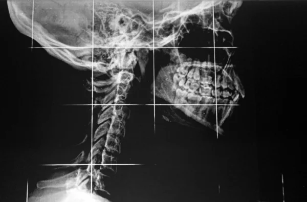 Radiografie krční páteře a čelisti — Stock fotografie