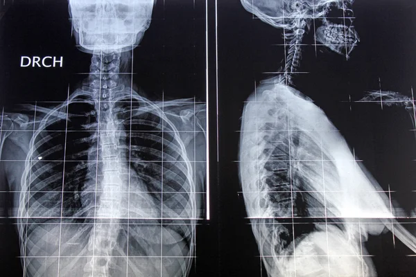Radiografía de espalda y perfil — Foto de Stock