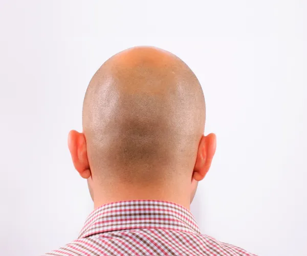 Baldness — Stock Photo, Image