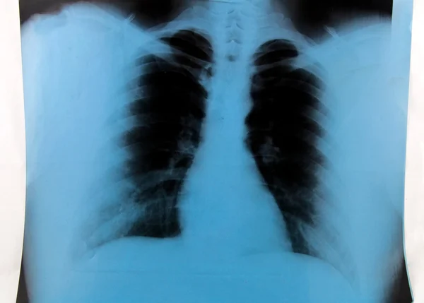 Radiografía de tórax — Foto de Stock
