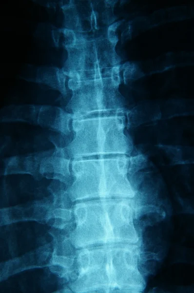 Radiografía de la columna vertebral humana — Foto de Stock