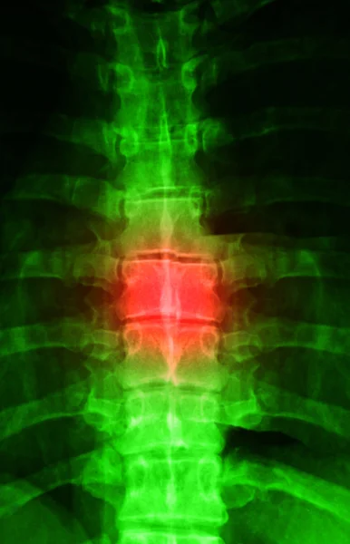Raio-X de uma coluna vertebral humana com vermelho para a dor — Fotografia de Stock