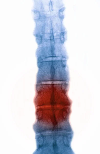 Röntgenfoto van een menselijke wervelkolom met rood voor pijn — Stockfoto