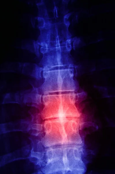 Radiografía de la columna vertebral humana — Foto de Stock