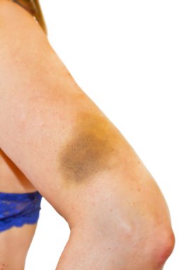 Woman with a hematoma at her upper arm clipart