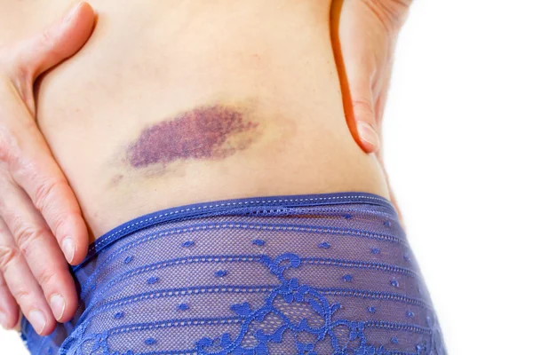 Woman with a hematoma at her upper hips — Stock Photo, Image
