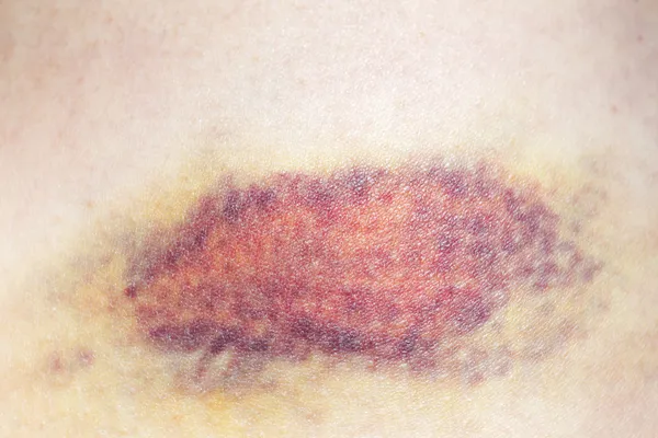 女性のボディの血腫 — ストック写真