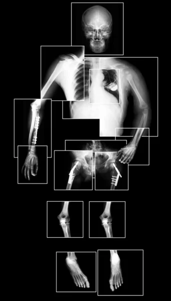 X-ray van longen — Stockfoto
