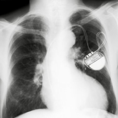 X-rayed chest clipart
