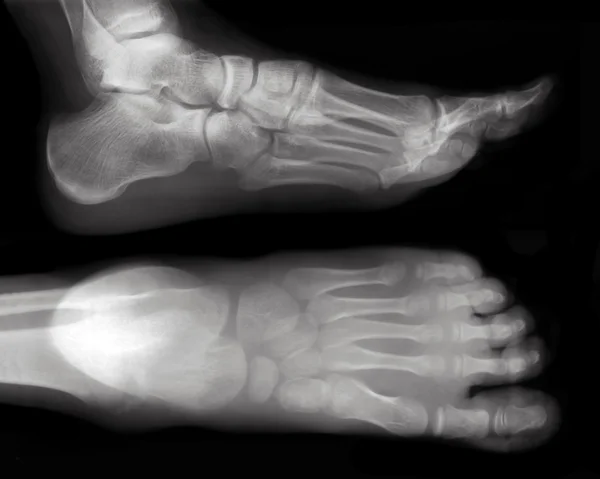 Radiografia del piede — Foto Stock