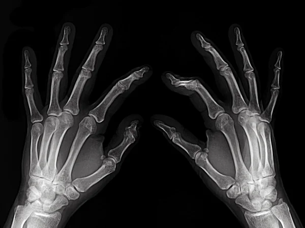 X 光检查的手 — 图库照片