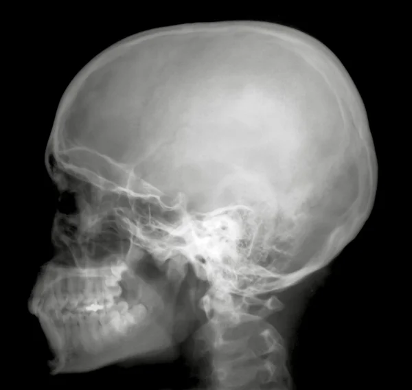 Рентгеновский профиль — стоковое фото