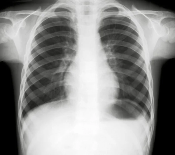 Röntgen der Lungen — Stockfoto