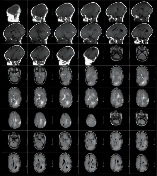 Mri 인간의 머리 스캔 — 스톡 사진